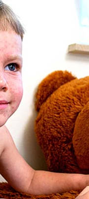 Chickenpox: managing the symptoms Chickenpox: managing the symptoms